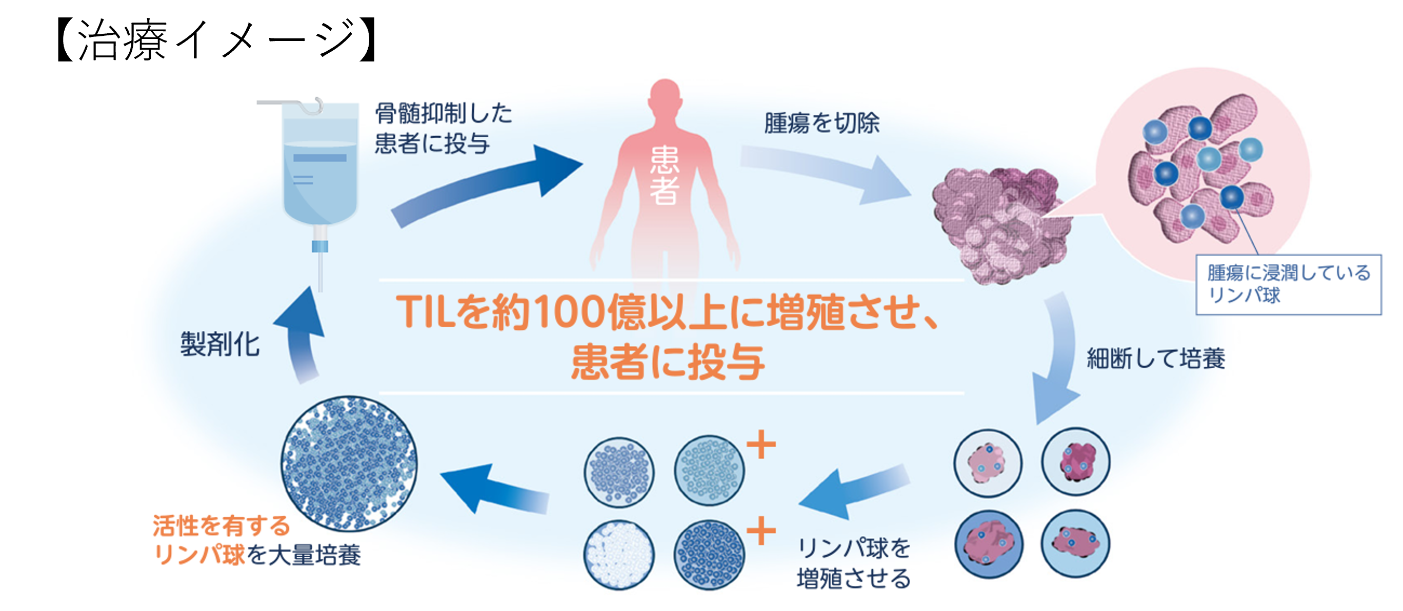 先進医療B】子宮頸がん・腫瘍浸潤リンパ球輸注療法（TIL療法